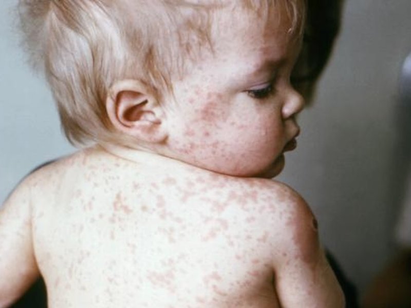 15_jan_2023_young_boy_with_measles.jpeg