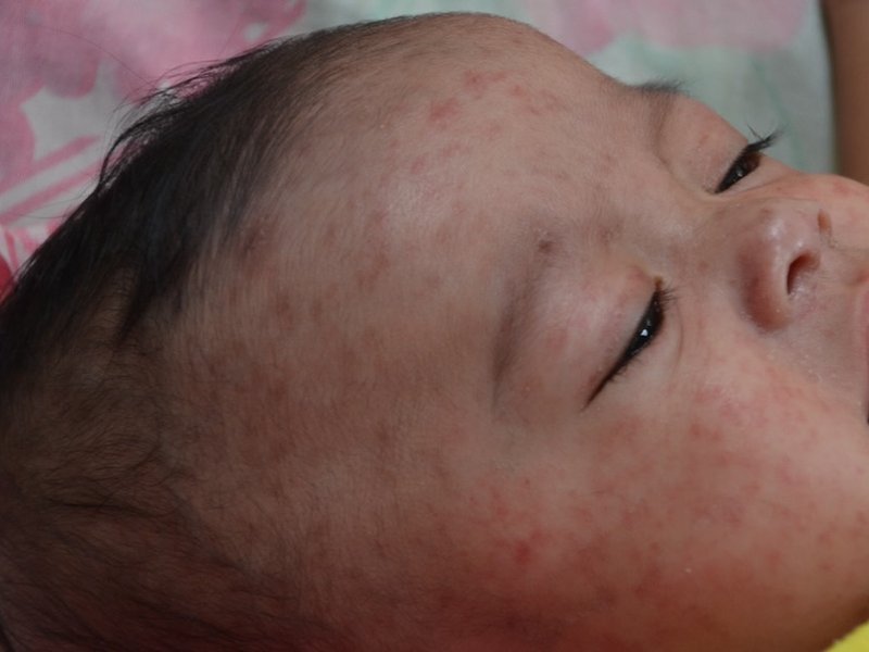 30_jan_2024_measles_child_philippines.jpg