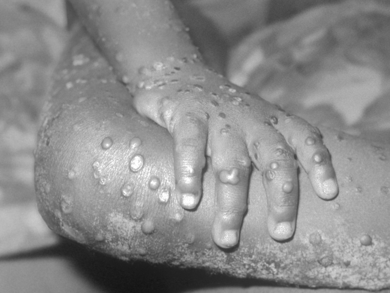 monkeypox.png
